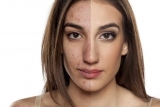 Best Treatments for Acne Scars Now Available in Delhi