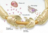 Chronic Inflammatory Demyelinating Polyneuropathy (CIDP) Market Witness a Remarkable Growth Projected By 2023