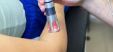 Top 3 Benefits of Class 4 Laser Therapy for Pain Management