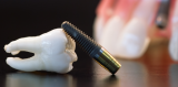 Dental Implants and Prosthetics Market Opportunity Assessment Study