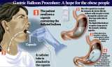 Gastric Balloon Procedure: A hope for the obese people