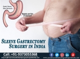 How to Get World Class Sleeve Gastrectomy Surgery in India