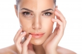 Hyperpigmentation Disorders Treatment Market by Products, Treatment, Increasing Prevalence