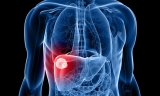 Liver cancer rates are rising