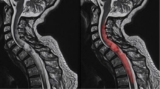 Living After Spine Tumor Surgery: Rehabilitation and Quality of Life