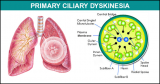 Primary ciliary dyskinesia (PCD) Market Research on Latest Developments, Classification, Treatment