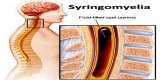 Syringomyelia Market Top Manufacturers, Technology and Statistical Research Report 2019