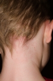 Tinea Corporis Market Opportunity,Size, Share, Technology Growth Report by Top Key Players