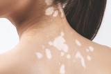 Best Vitiligo Treatment in Delhi
