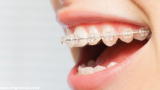 Invisible Braces Treatment , Cost And Procedure
