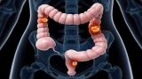 Colorectal Cancer Market Key Companies, Diagnosis, Treatment, and Drug Delivery for Major Applications