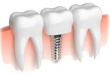 Same Day Dental Implants In Jaipur – DNG Dental Clinic