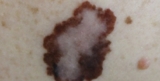 Effective Solutions for Wart and Wrinkle Treatment in Mission Viejo, CA