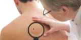 What’s the Best Way to Treat Basal Cell Carcinoma in Long Beach, CA? A Friendly Guide