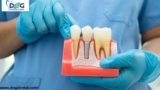 Immediate Dental Implant In Jaipur: A Lifeline For Your Smile